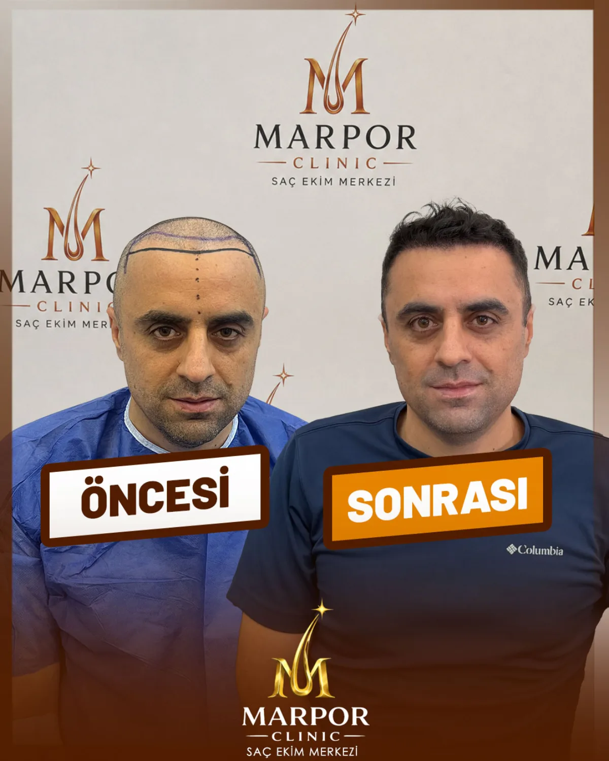Saç ekimi öncesi ve sonrası - Hasta 6